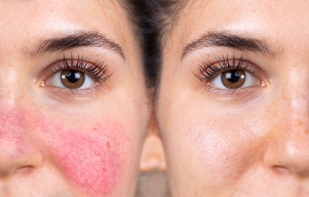 Understanding Rosacea