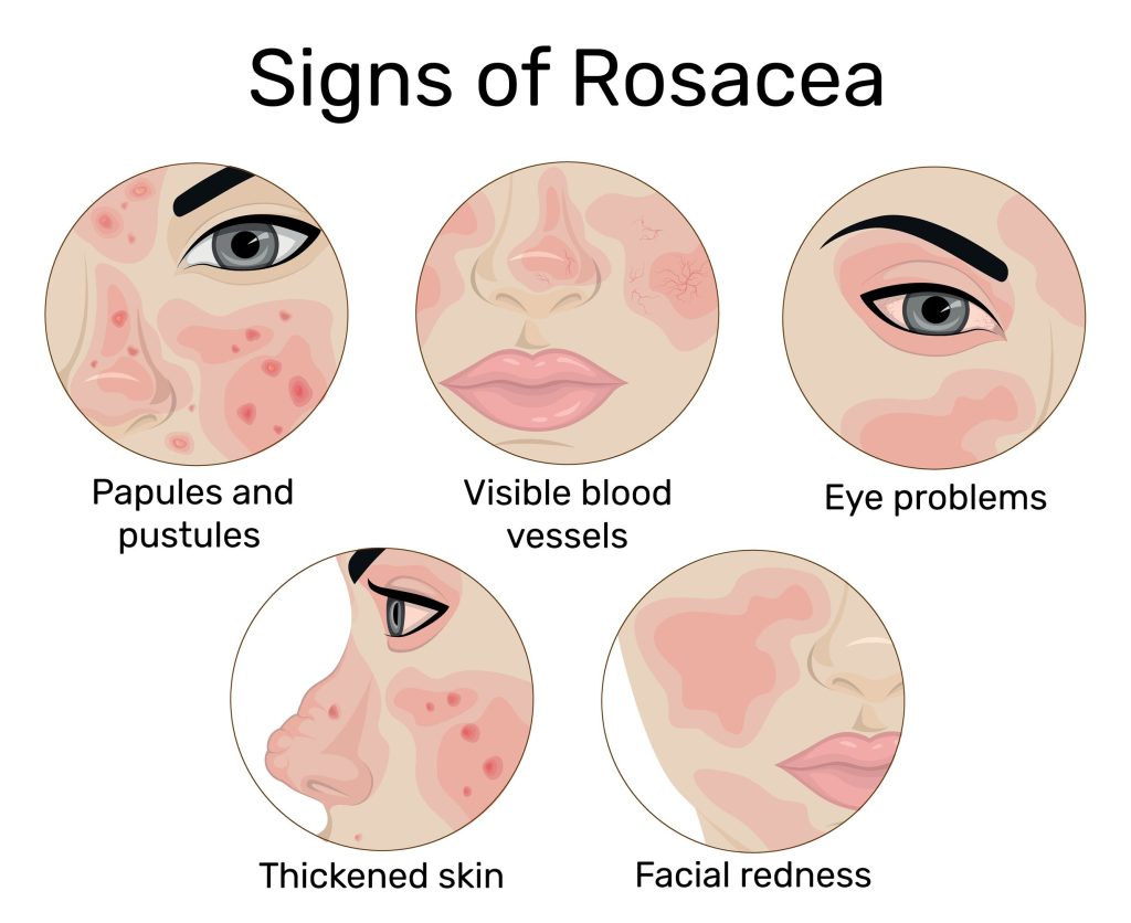 rosacea symptoms