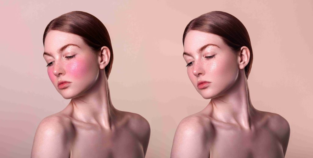 rosacea skin care: redness correction