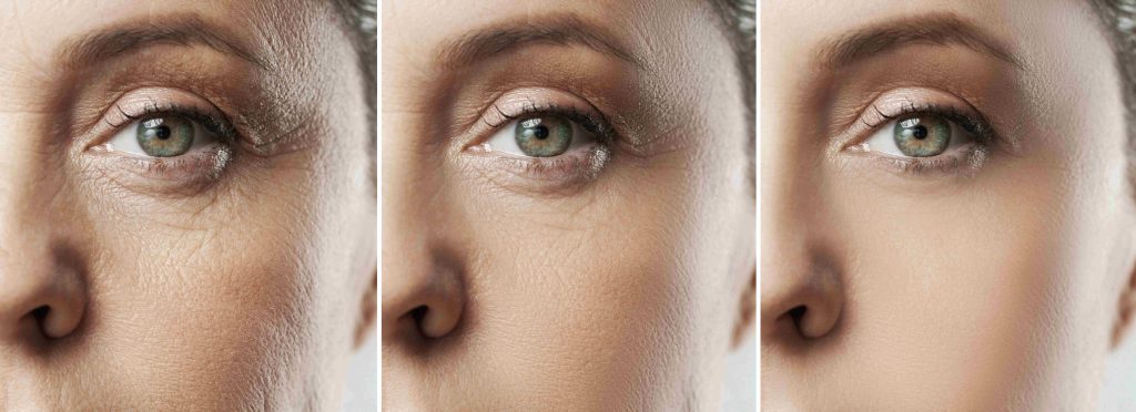 loss of volume is a common cause for dark circles under eyes