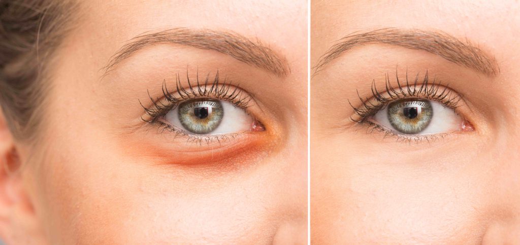 blepharoplasty and lipofilling can help take out dark circles under eyes 