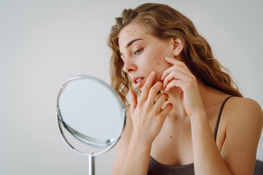 One of the most common face issues caused by stress is acne.