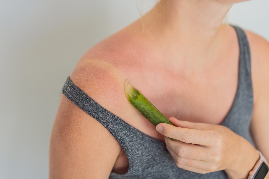 sunburn relief