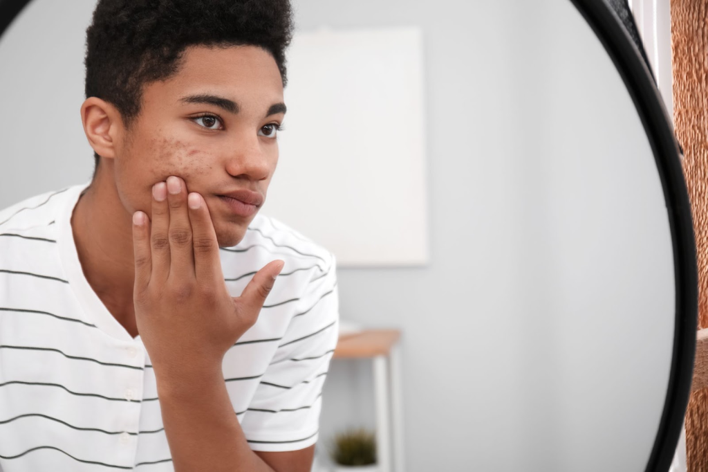 does sugar cause acne