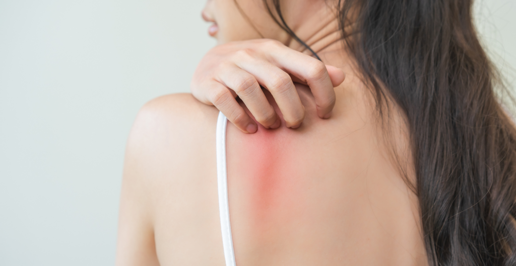 how to prevent chafing in groin area female