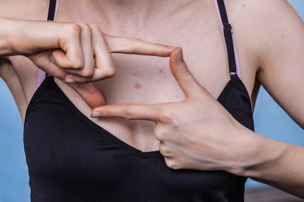 what causes chest acne