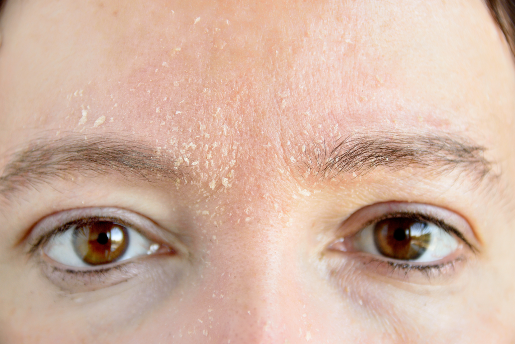 overplucked eyebrows and dry skin leading to hair thinness