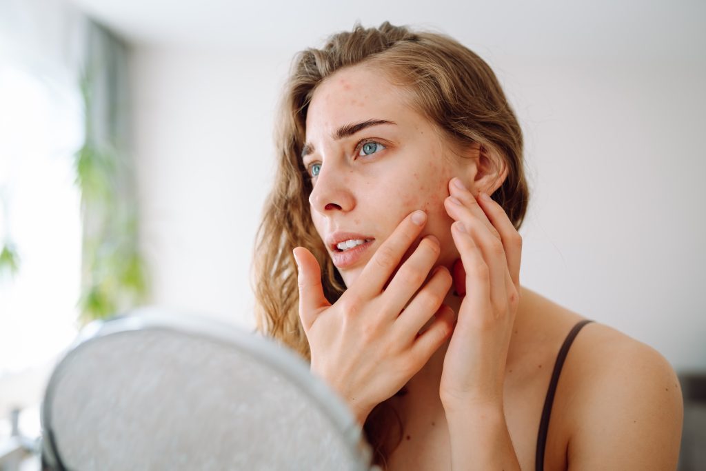 a young woman examines her acne