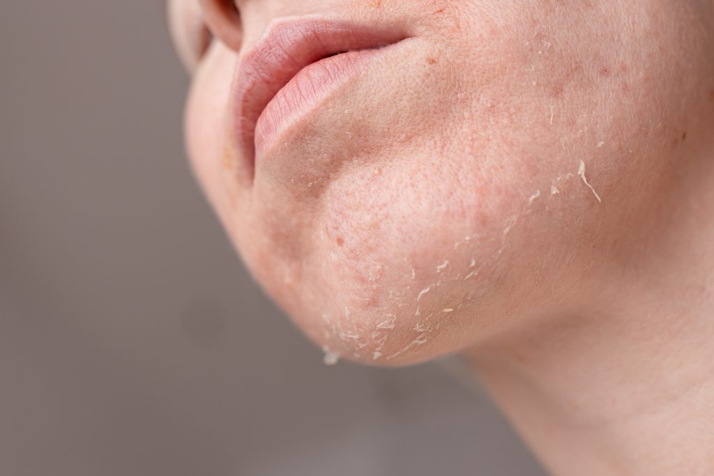 a woman with dry skin on her chin