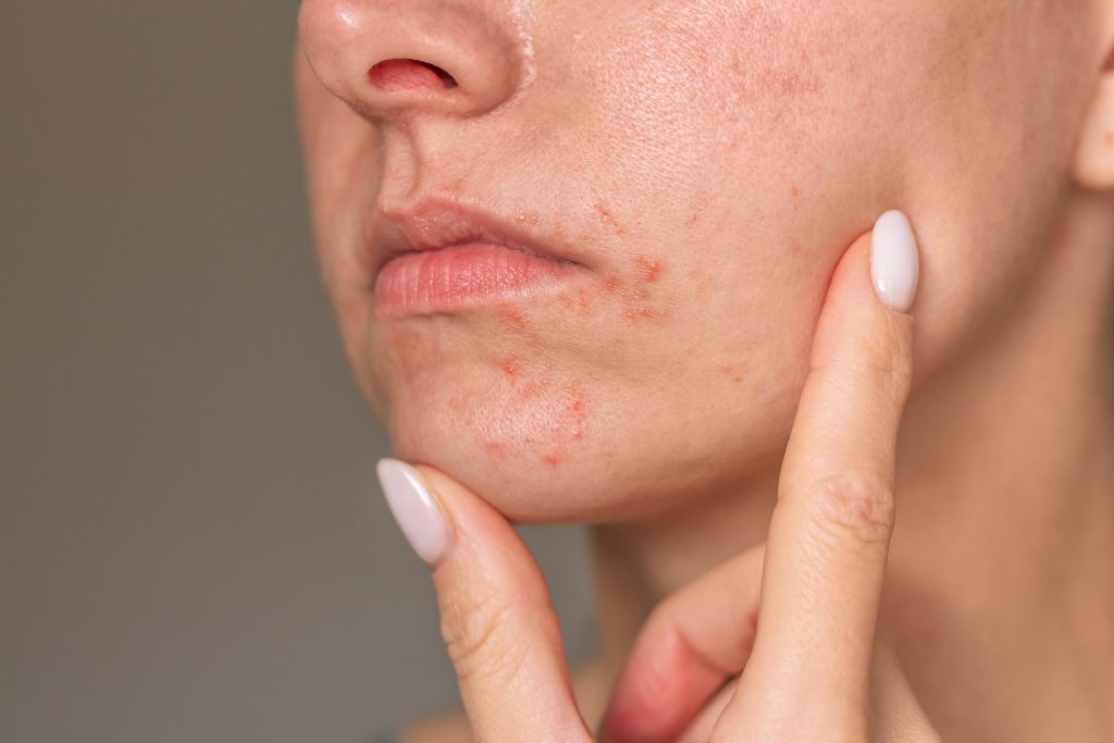 Close-up photo of a young woman suffering from perioral dermatitis