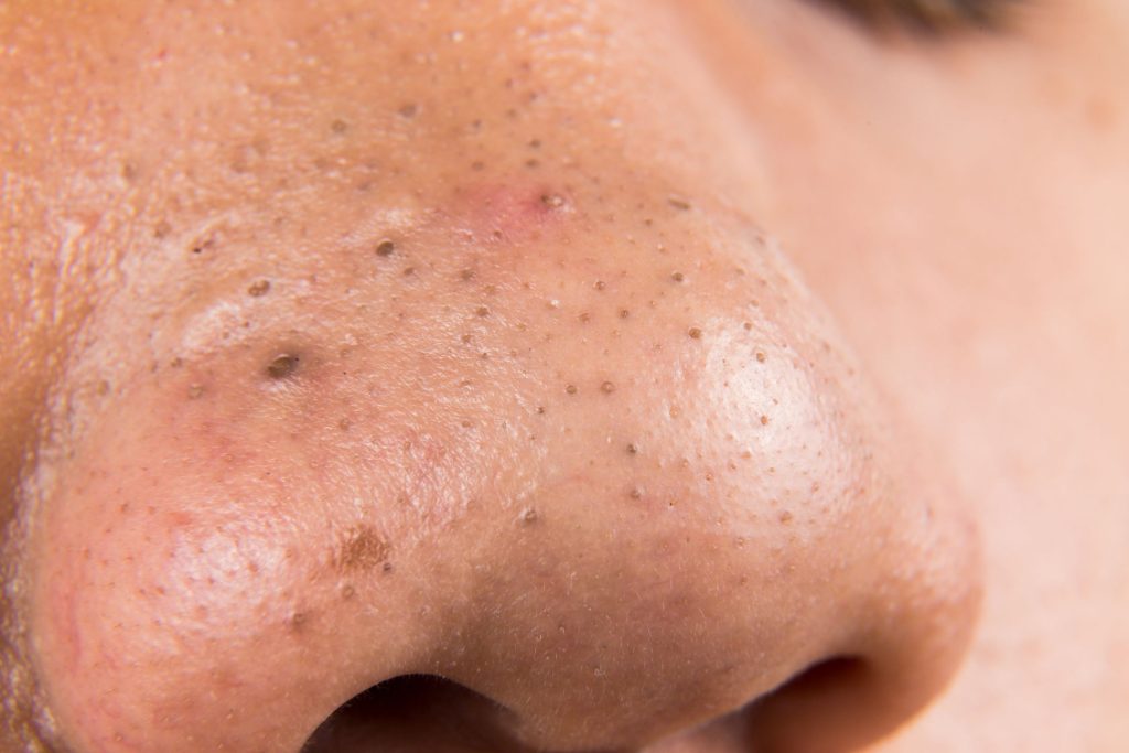 what acne look like on the face