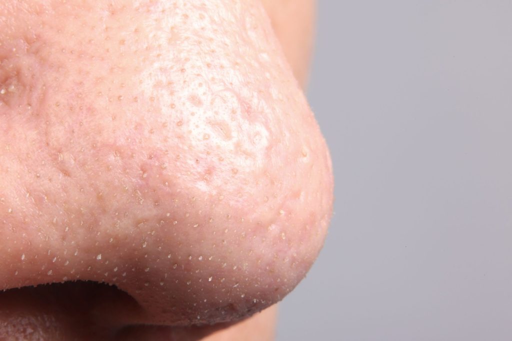 what sebaceous filaments look like on the face