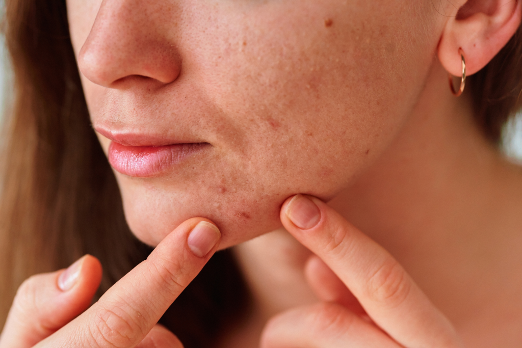 skin breakout treatment