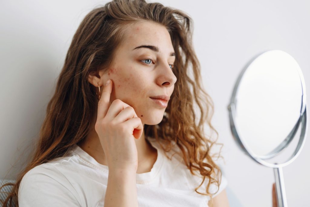 hypochlorous acid takes on acne