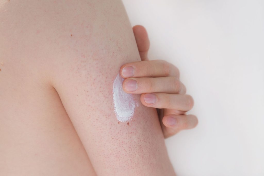 how to treat keratosis pilaris right