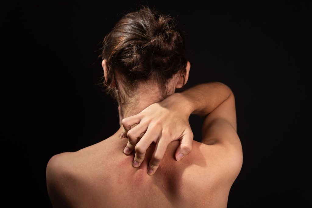 how to get rid of keratosis pilaris